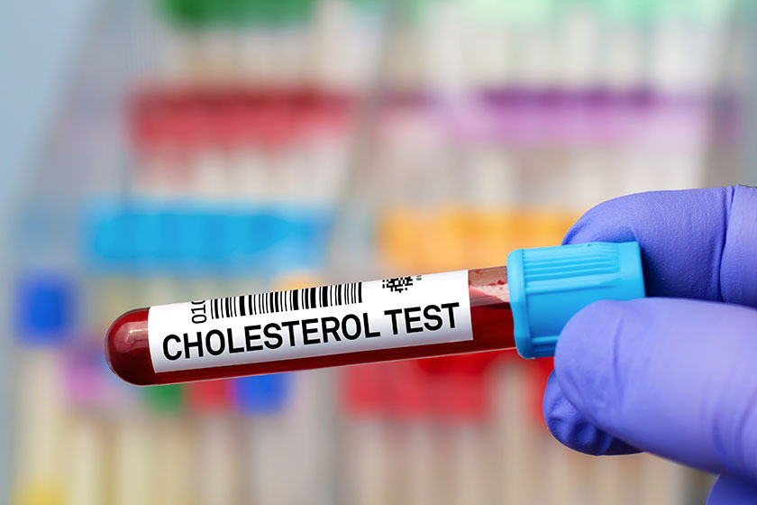 Doctor with Blood tube test for Cholesterol test. Blood sample of patient for analysis of Cholesterol test in laboratory